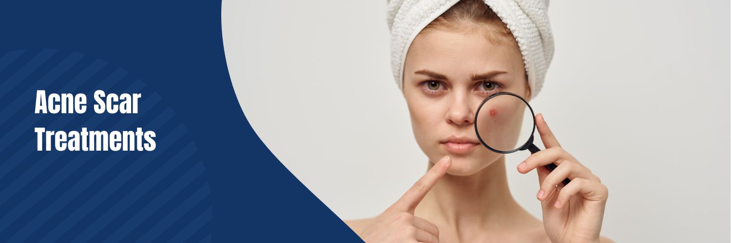 Acne Scar Treatments